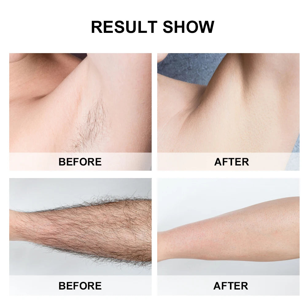 IPL Laser Hair Removal Device – Professional & Gentle.