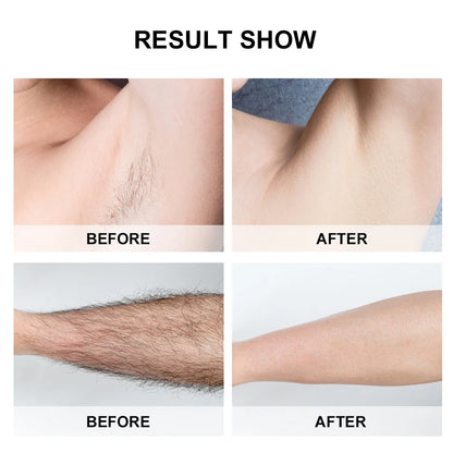 IPL Laser Hair Removal Device – Professional & Gentle.