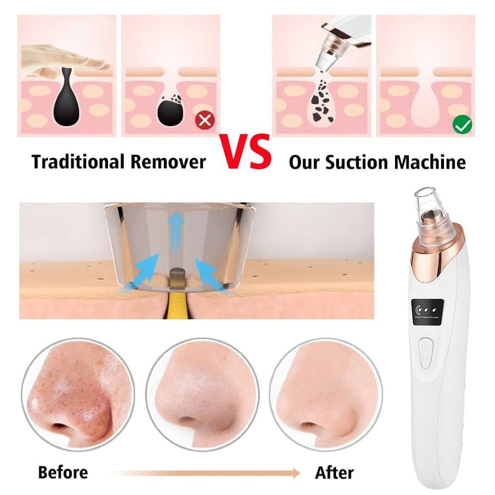 5 in 1 Blackhead remover | Derma Suction | Rechargeable