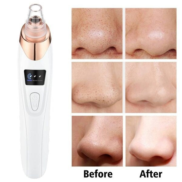 5 in 1 Blackhead remover | Derma Suction | Rechargeable